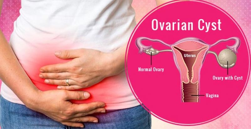 Several Points where the Ovarian Cysts can be Understood